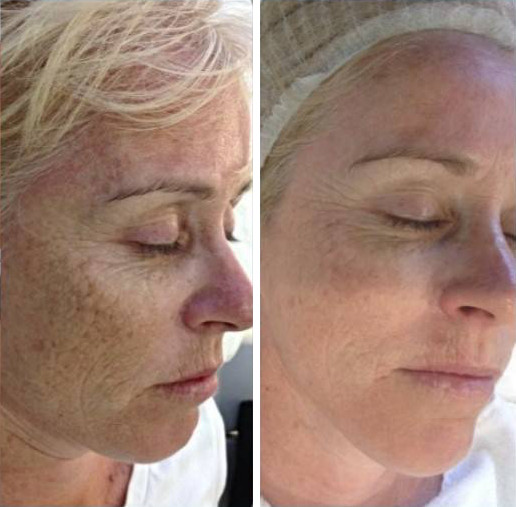 soin microneedling marseille resultat 1